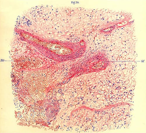 An illustration from von Economo's Die Encephalitis lethargica (1918) showing brain tissue of a monkey affected by encephalitis lethargica, as seen under a microscope.