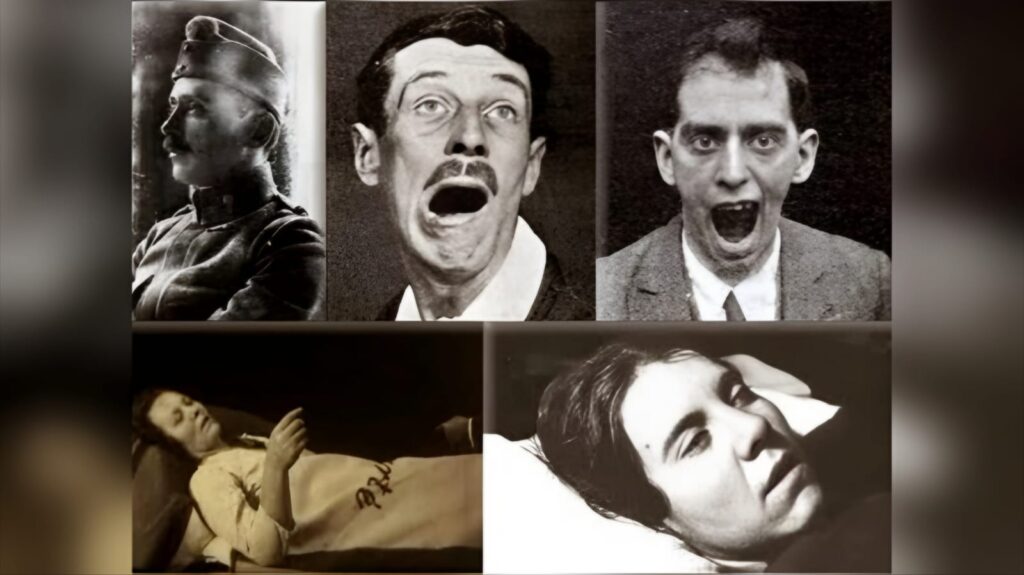 Von Economo (On the Top Left) and the patients affected by encephalitis lethargica.