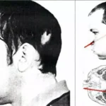 On July 13, 1978, a proton beam pierced the head of Russian physicist Anatoly Bugorsky, but he survived.