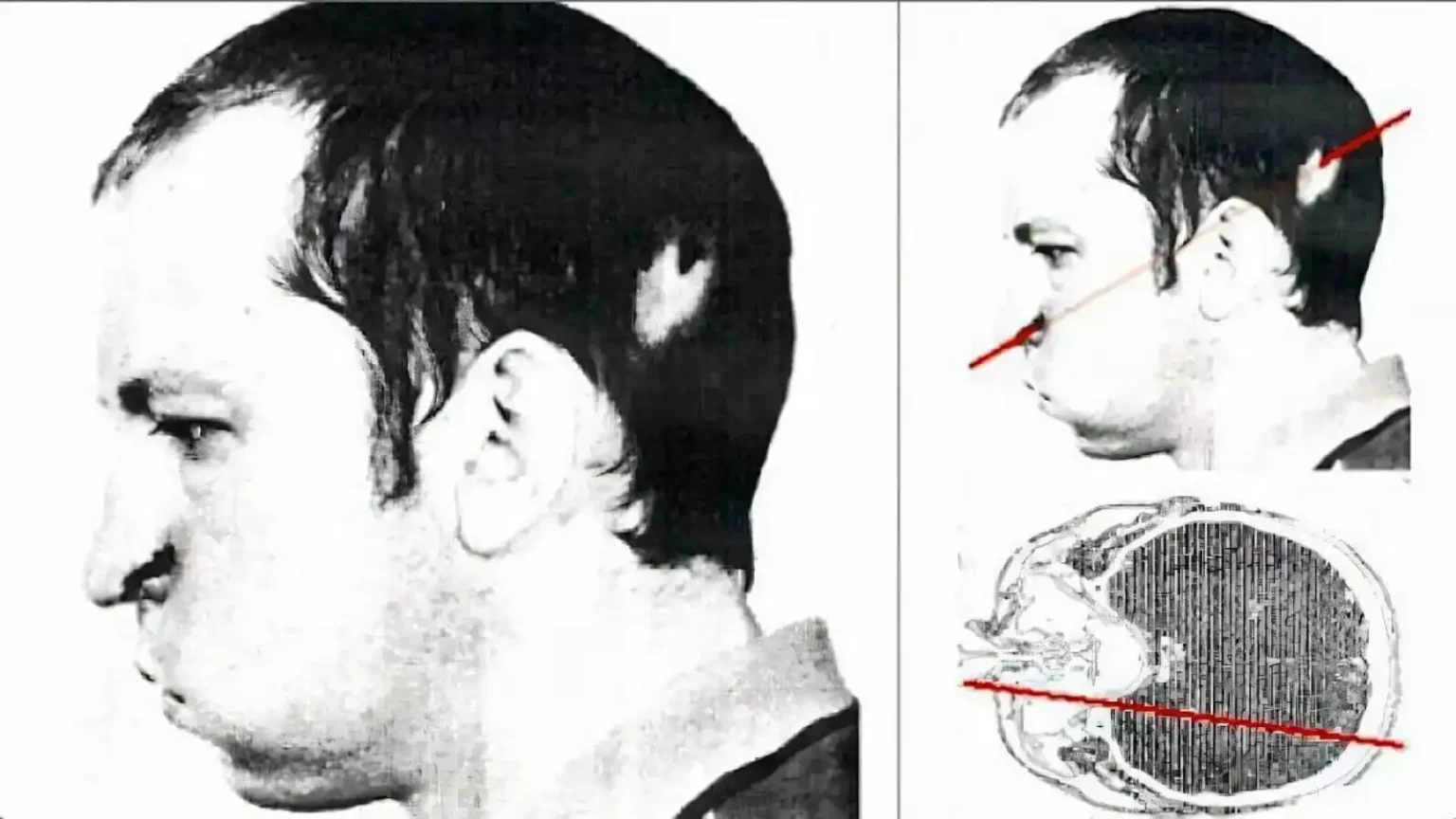 On July 13, 1978, a proton beam pierced the head of Russian physicist Anatoly Bugorsky, but he survived.