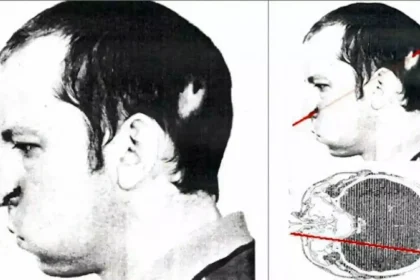 On July 13, 1978, a proton beam pierced the head of Russian physicist Anatoly Bugorsky, but he survived.