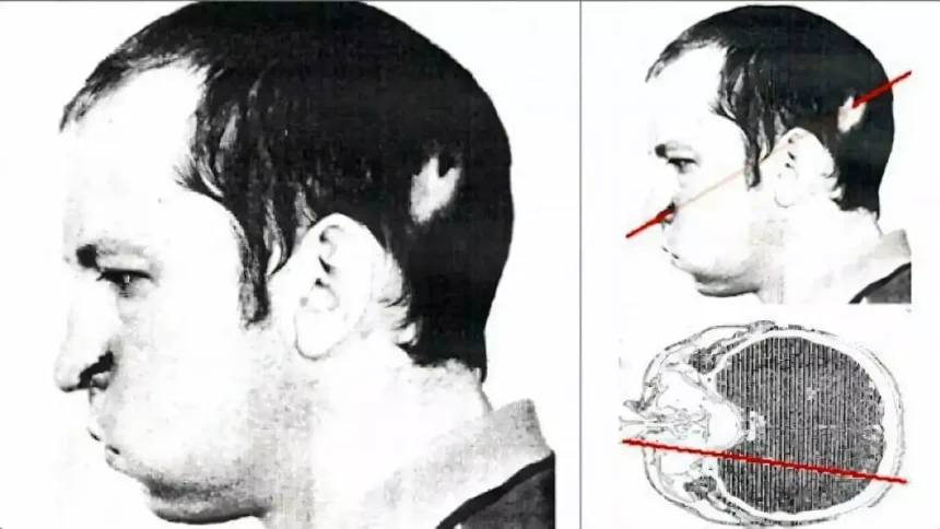 On July 13, 1978, a proton beam pierced the head of Russian physicist Anatoly Bugorsky, but he survived.
