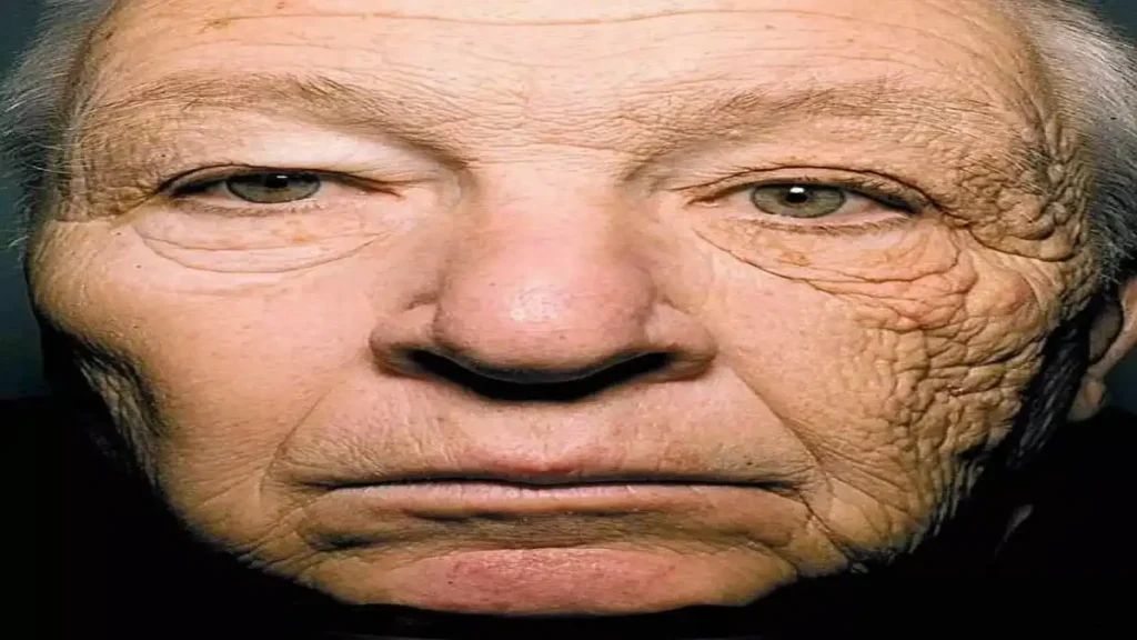 Anatoli Burgowski's face aged more slowly on the side paralyzed by the proton beam than on the non-paralyzed side.