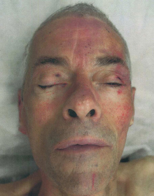Post-mortem identification photograph of the unidentified man known as “Peter Bergmann,” showing a close-up of his face after he was found dead at Rosses Point, County Sligo, in June 2009.