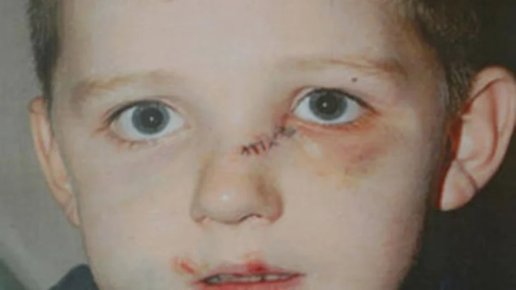 Nine-year-old Nathan Thomson showing the physical scars of the assault.