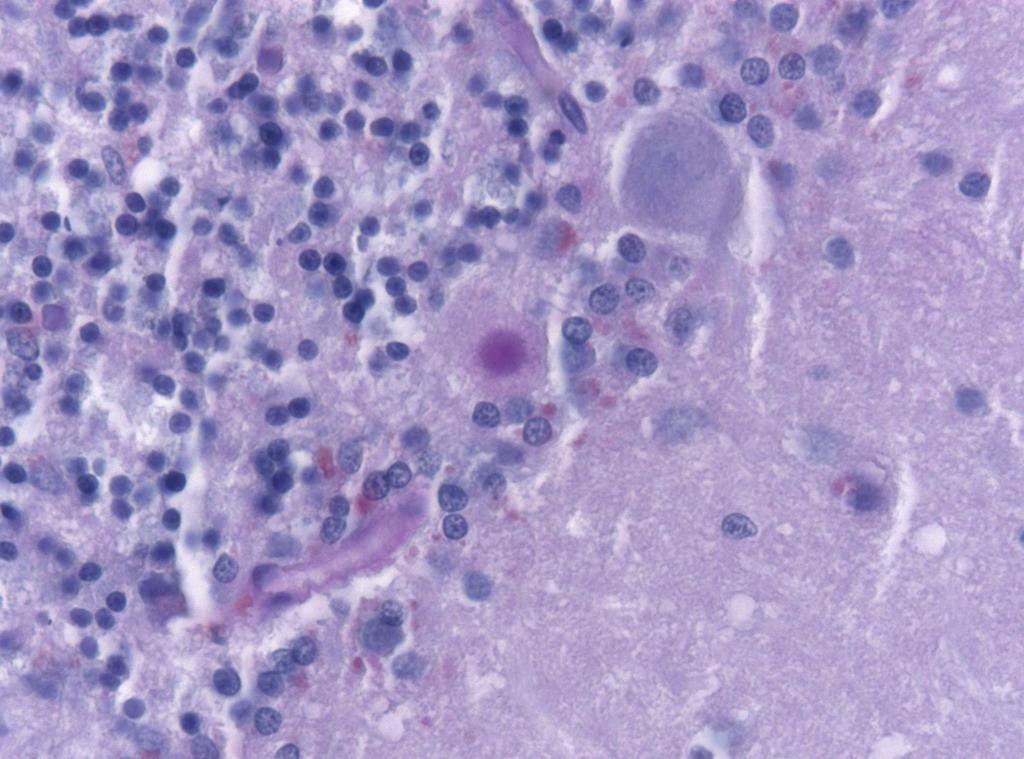 Microscopic image of brain tissue affected by kuru showing an amyloid plaque in the cerebellum.